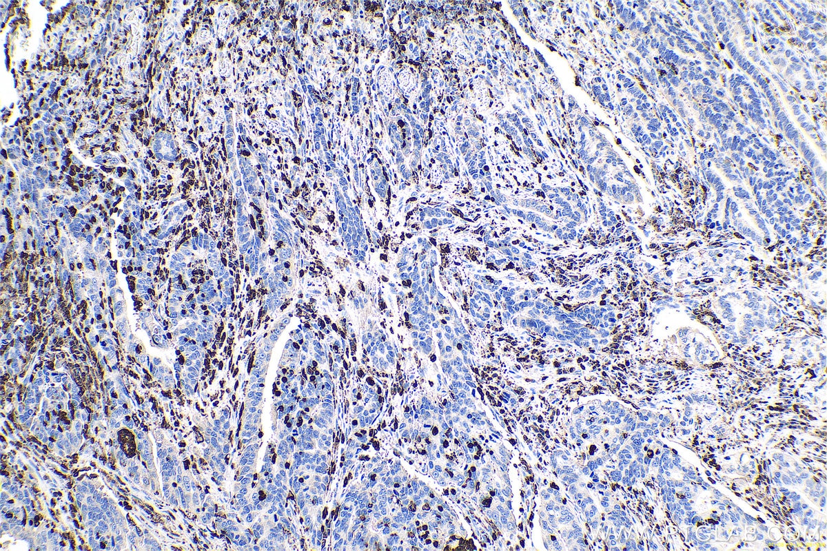 Immunohistochemical analysis of paraffin-embedded human stomach cancer tissue slide using KHC0702 (CORO1A IHC Kit).