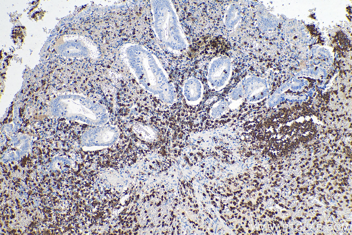 Immunohistochemical analysis of paraffin-embedded human appendicitis tissue slide using KHC0702 (CORO1A IHC Kit).