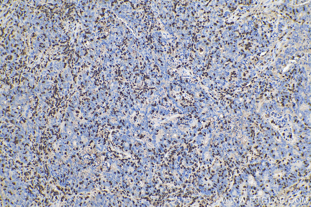 Immunohistochemical analysis of paraffin-embedded human colon cancer tissue slide using KHC0702 (CORO1A IHC Kit).