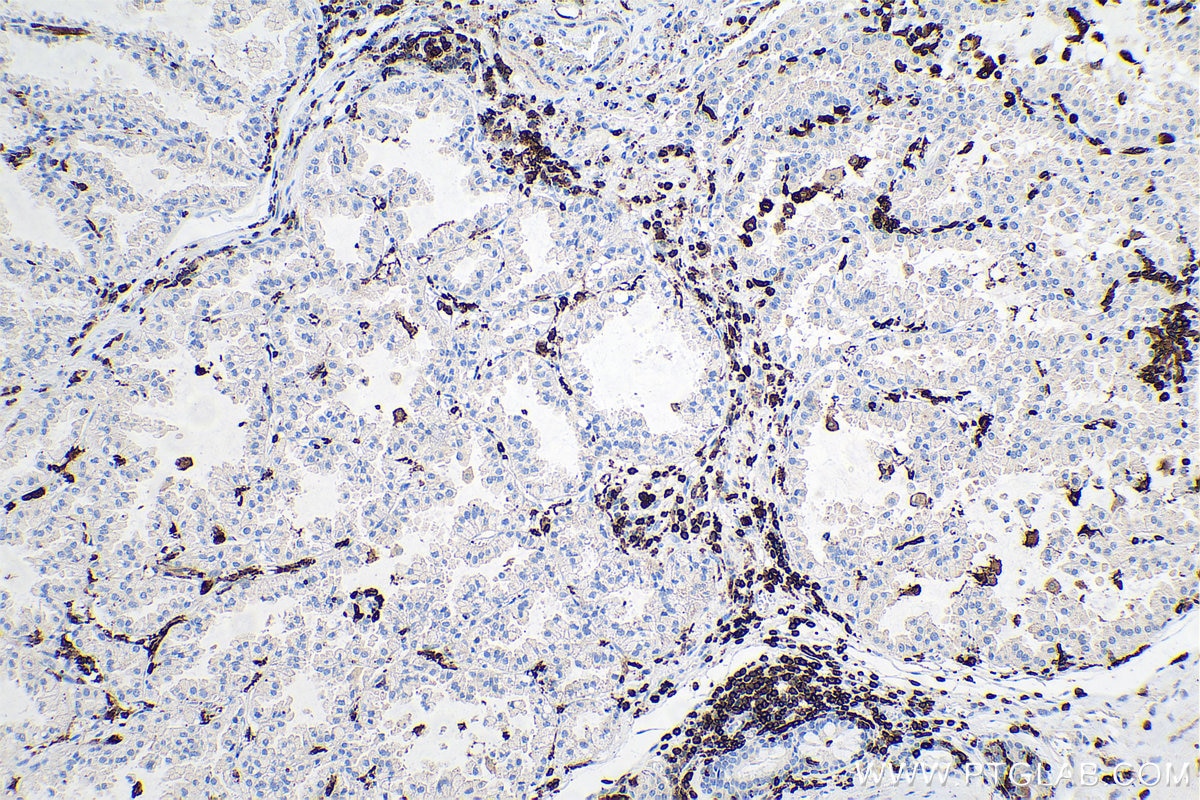 Immunohistochemical analysis of paraffin-embedded human lung cancer tissue slide using KHC0702 (CORO1A IHC Kit).