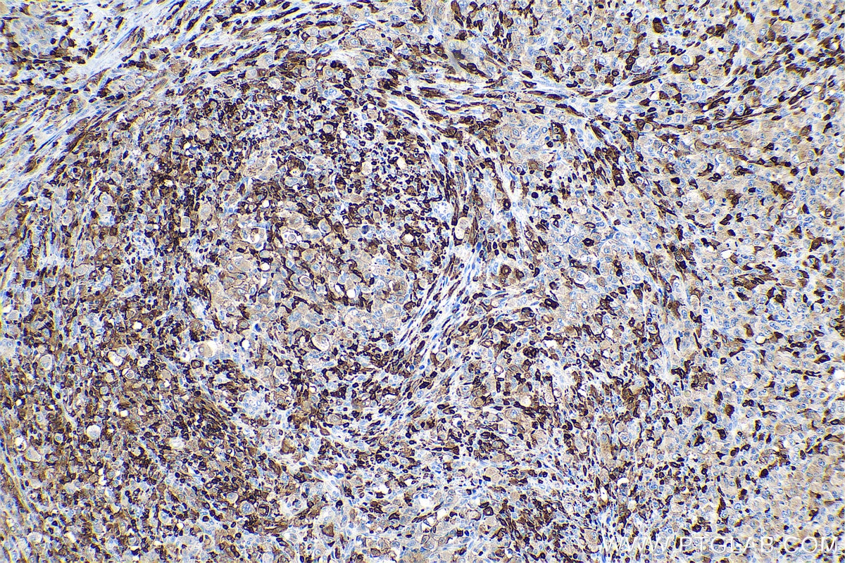 Immunohistochemical analysis of paraffin-embedded human lymphoma tissue slide using KHC0702 (CORO1A IHC Kit).
