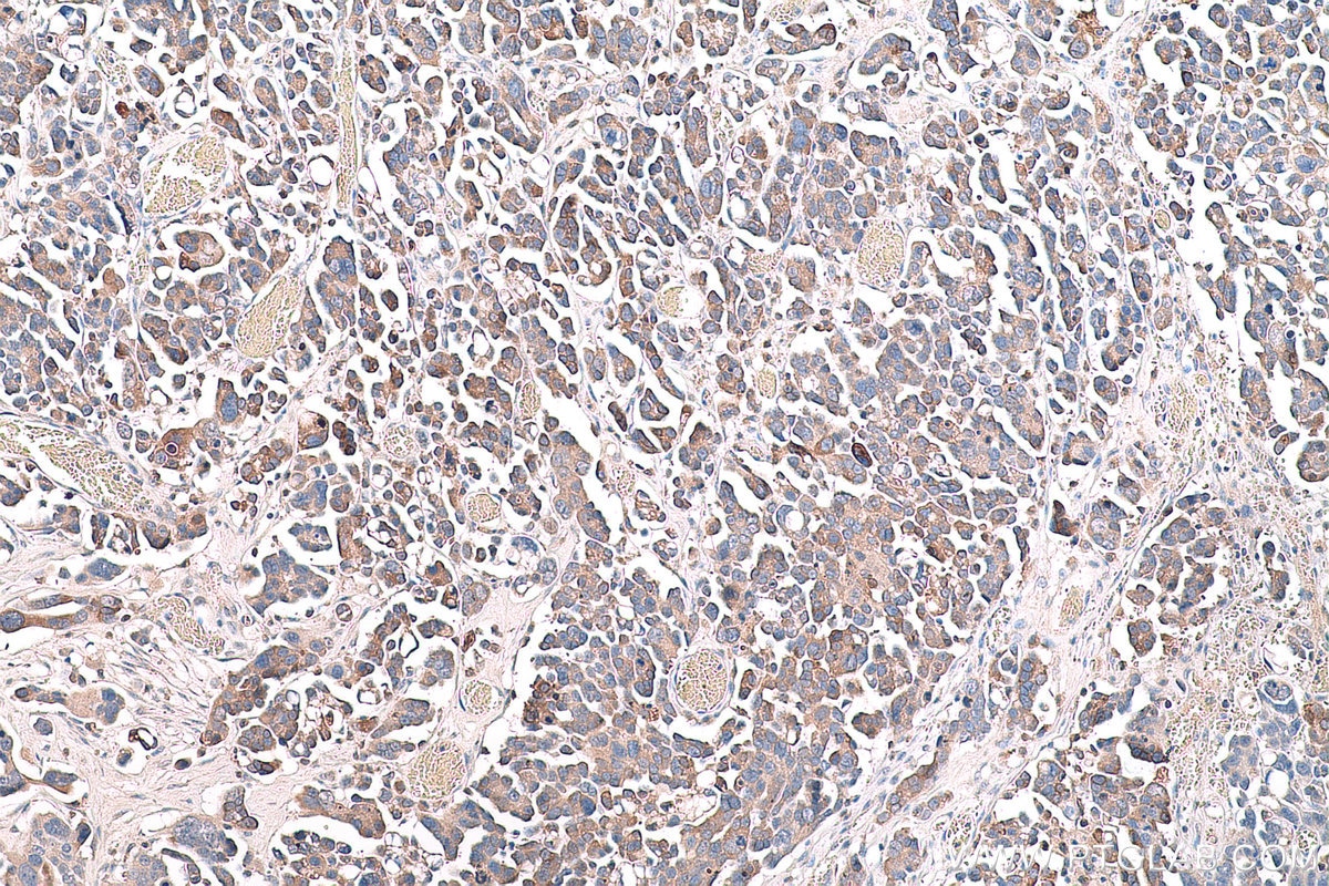 Immunohistochemical analysis of paraffin-embedded human colon cancer tissue slide using KHC0770 (COX2 IHC Kit).
