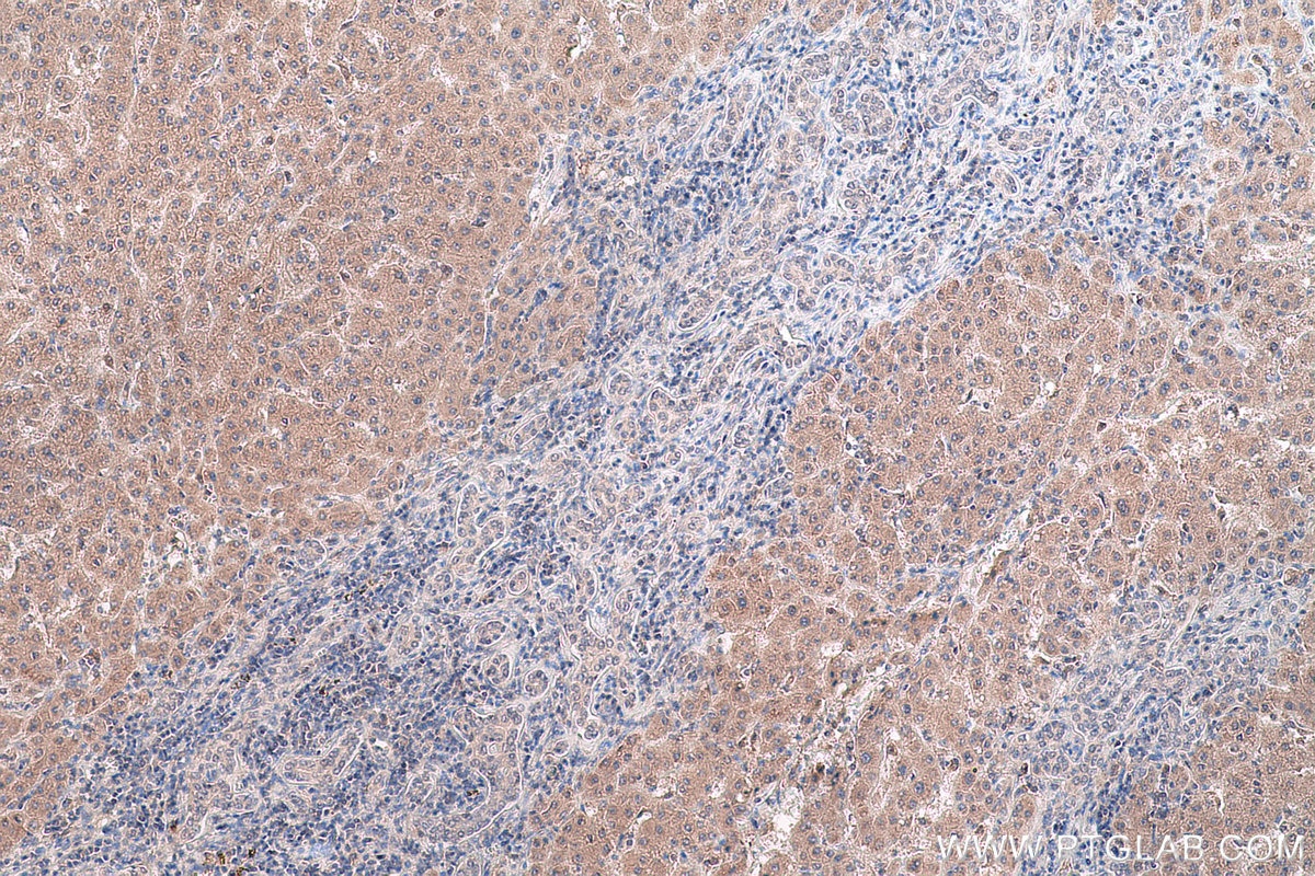 Immunohistochemical analysis of paraffin-embedded human liver cancer tissue slide using KHC0770 (COX2 IHC Kit).