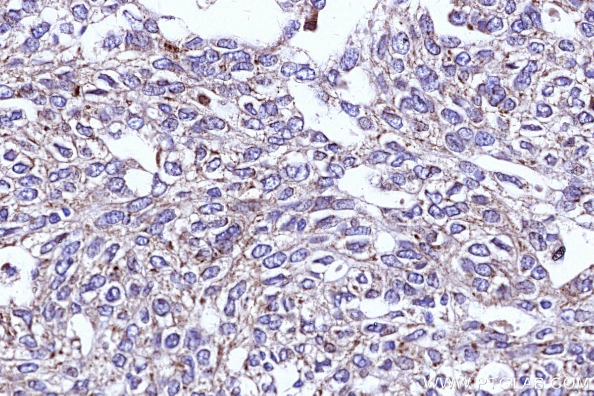 Immunohistochemical analysis of paraffin-embedded human ovary cancer tissue slide using KHC3142 (COX4NB IHC Kit).