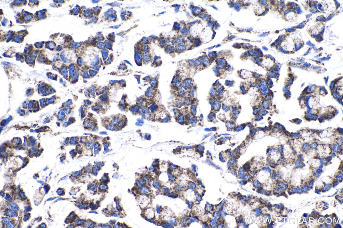 Immunohistochemical analysis of paraffin-embedded human colon cancer tissue slide using KHC1025 (COX5A IHC Kit).