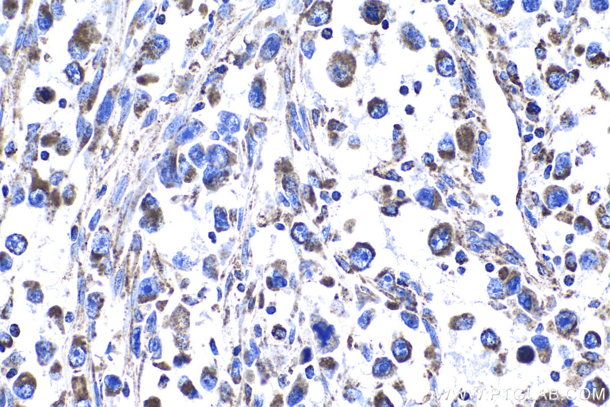 Immunohistochemical analysis of paraffin-embedded human lung cancer tissue slide using KHC1025 (COX5A IHC Kit).