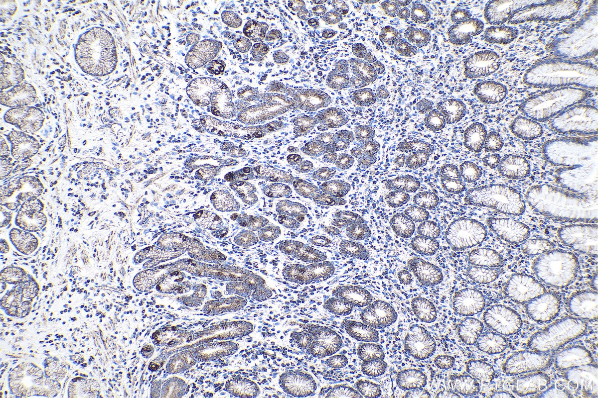 Immunohistochemical analysis of paraffin-embedded human stomach cancer tissue slide using KHC1025 (COX5A IHC Kit).