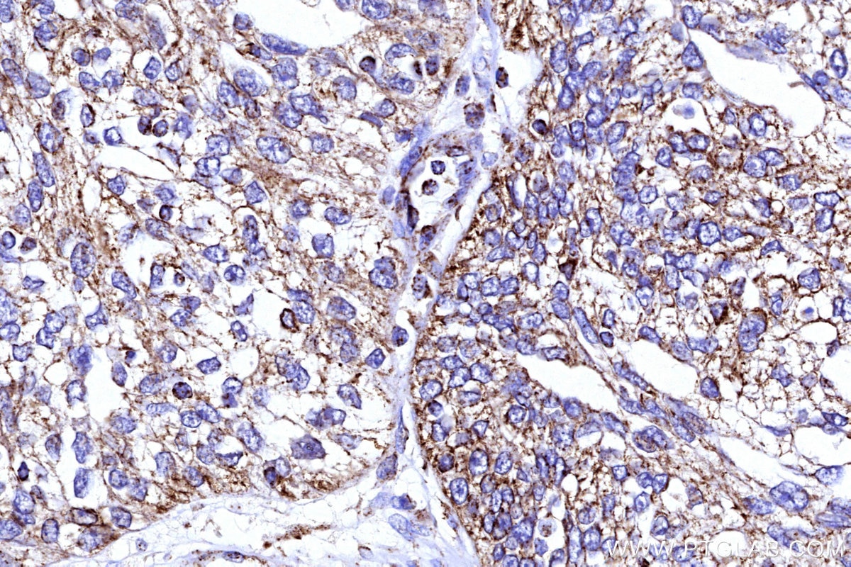 Immunohistochemical analysis of paraffin-embedded human ovary cancer tissue slide using KHC3176 (COX5B IHC Kit). Immunohistochemical analysis of paraffin-embedded human ovary cancer tissue slide using KHC3176 (COX5B IHC Kit).