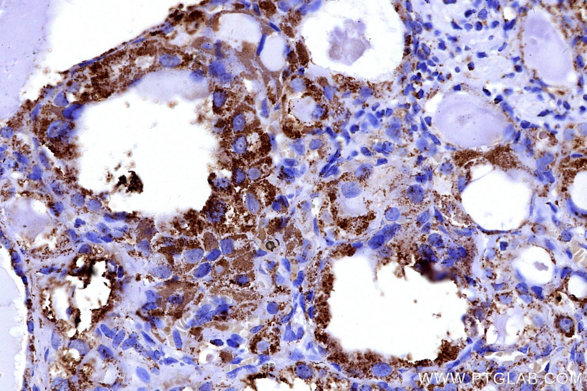 Immunohistochemical analysis of paraffin-embedded human thyroid cancer tissue slide using KHC3176 (COX5B IHC Kit). Immunohistochemical analysis of paraffin-embedded human thyroid cancer tissue slide using KHC3176 (COX5B IHC Kit).