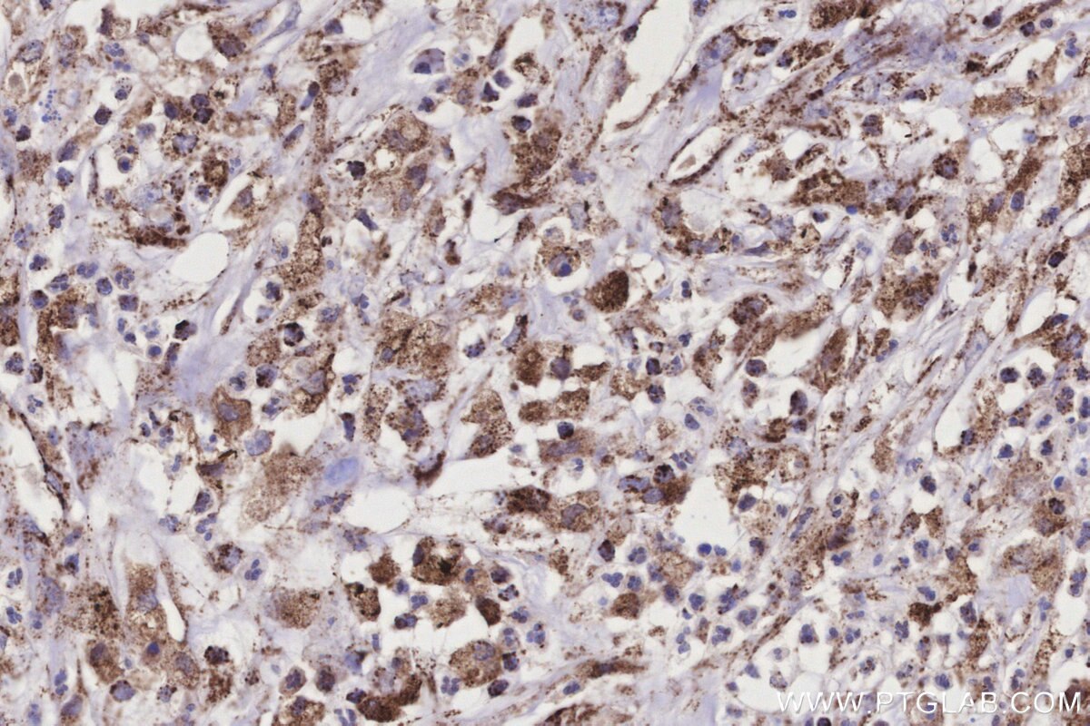 Immunohistochemical analysis of paraffin-embedded human colon cancer tissue slide using KHC3179 (COX6A1 IHC Kit).