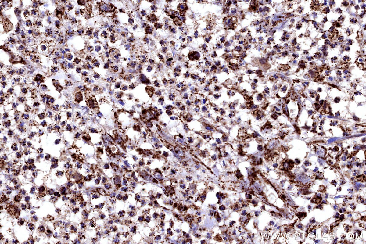 Immunohistochemical analysis of paraffin-embedded human colon cancer tissue slide using KHC3183 (COX6B1 IHC Kit). Immunohistochemical analysis of paraffin-embedded human colon cancer tissue slide using KHC3183 (COX6B1 IHC Kit).