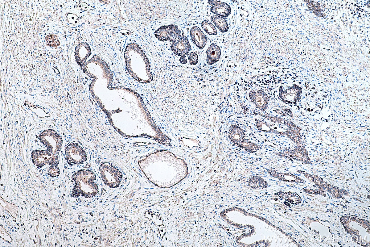 Immunohistochemical analysis of paraffin-embedded human prostate cancer tissue slide using KHC0305 (COX8A IHC Kit).