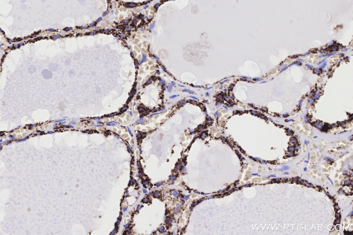 Immunohistochemical analysis of paraffin-embedded human thyroid cancer tissue slide using KHC3182 (COXIV IHC Kit).