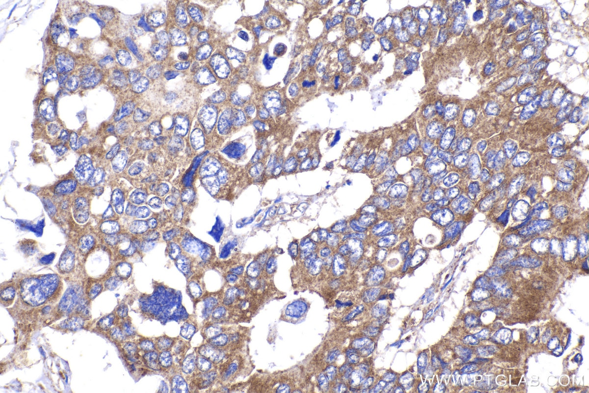 Immunohistochemical analysis of paraffin-embedded human stomach cancer tissue slide using KHC2079 (CP110 IHC Kit).