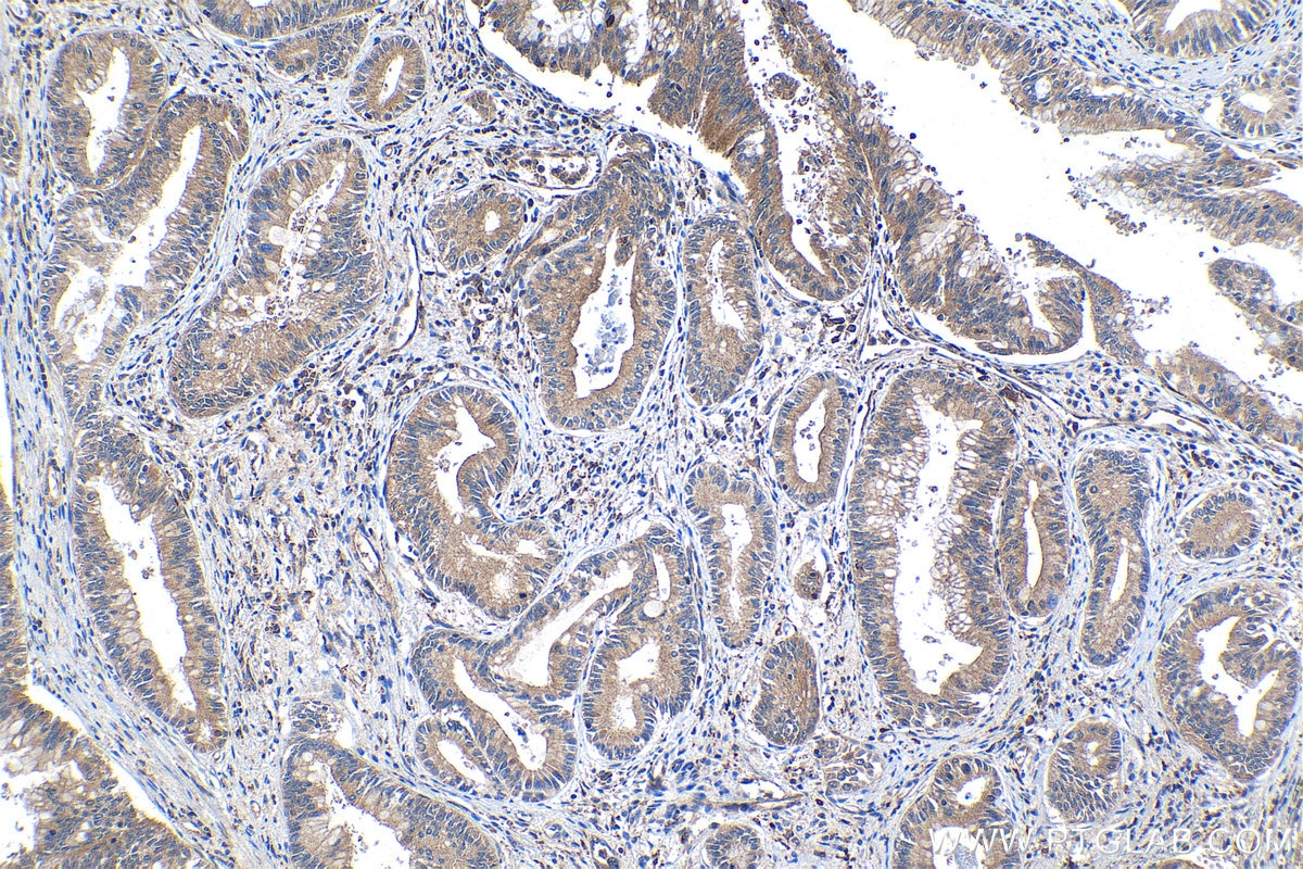 Immunohistochemical analysis of paraffin-embedded human pancreas cancer tissue slide using KHC1331 (CPA1 IHC Kit).