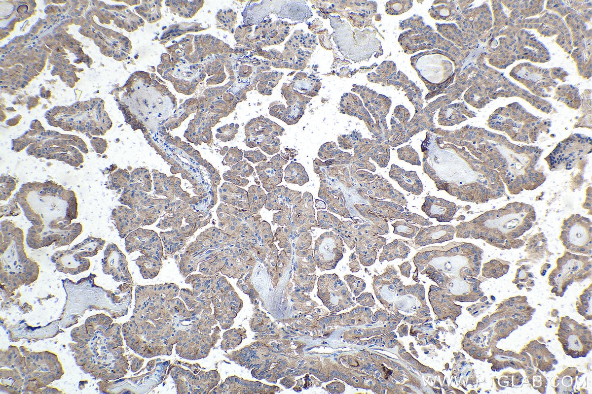 Immunohistochemical analysis of paraffin-embedded human thyroid cancer tissue slide using KHC1835 (CPEB3 IHC Kit).