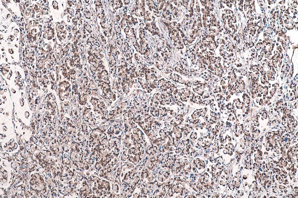 Immunohistochemical analysis of paraffin-embedded human colon cancer tissue slide using KHC0962 (CPNE1 IHC Kit).