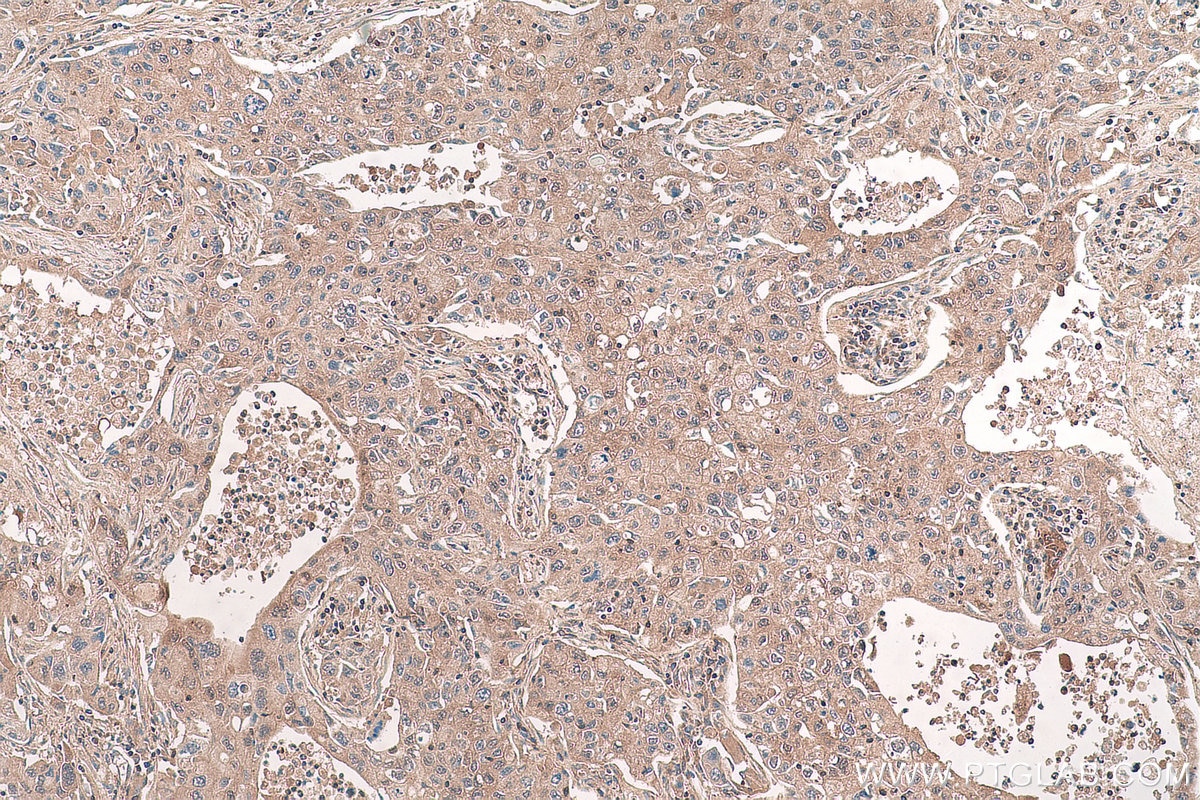 Immunohistochemical analysis of paraffin-embedded human lung cancer tissue slide using KHC0962 (CPNE1 IHC Kit).