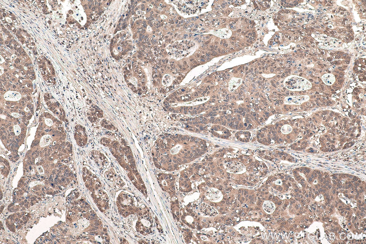 Immunohistochemical analysis of paraffin-embedded human stomach cancer tissue slide using KHC0962 (CPNE1 IHC Kit).