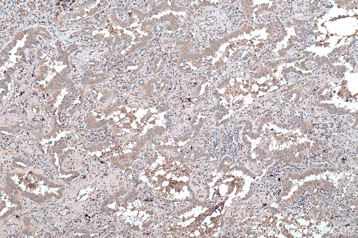 Immunohistochemical analysis of paraffin-embedded human lung cancer tissue slide using KHC0412 (CPNE8 IHC Kit).
