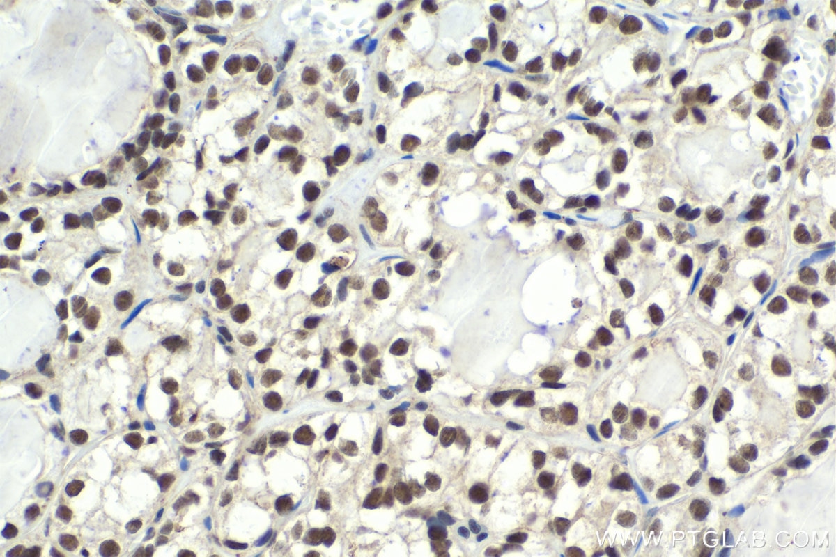 Immunohistochemical analysis of paraffin-embedded human thyroid cancer tissue slide using KHC1991 (CPSF3 IHC Kit).