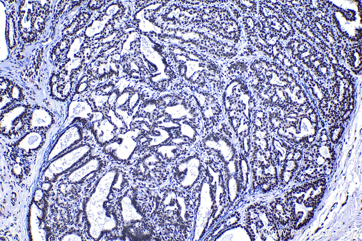 Immunohistochemical analysis of paraffin-embedded human breast cancer tissue slide using KHC1388 (CPSF6 IHC Kit).