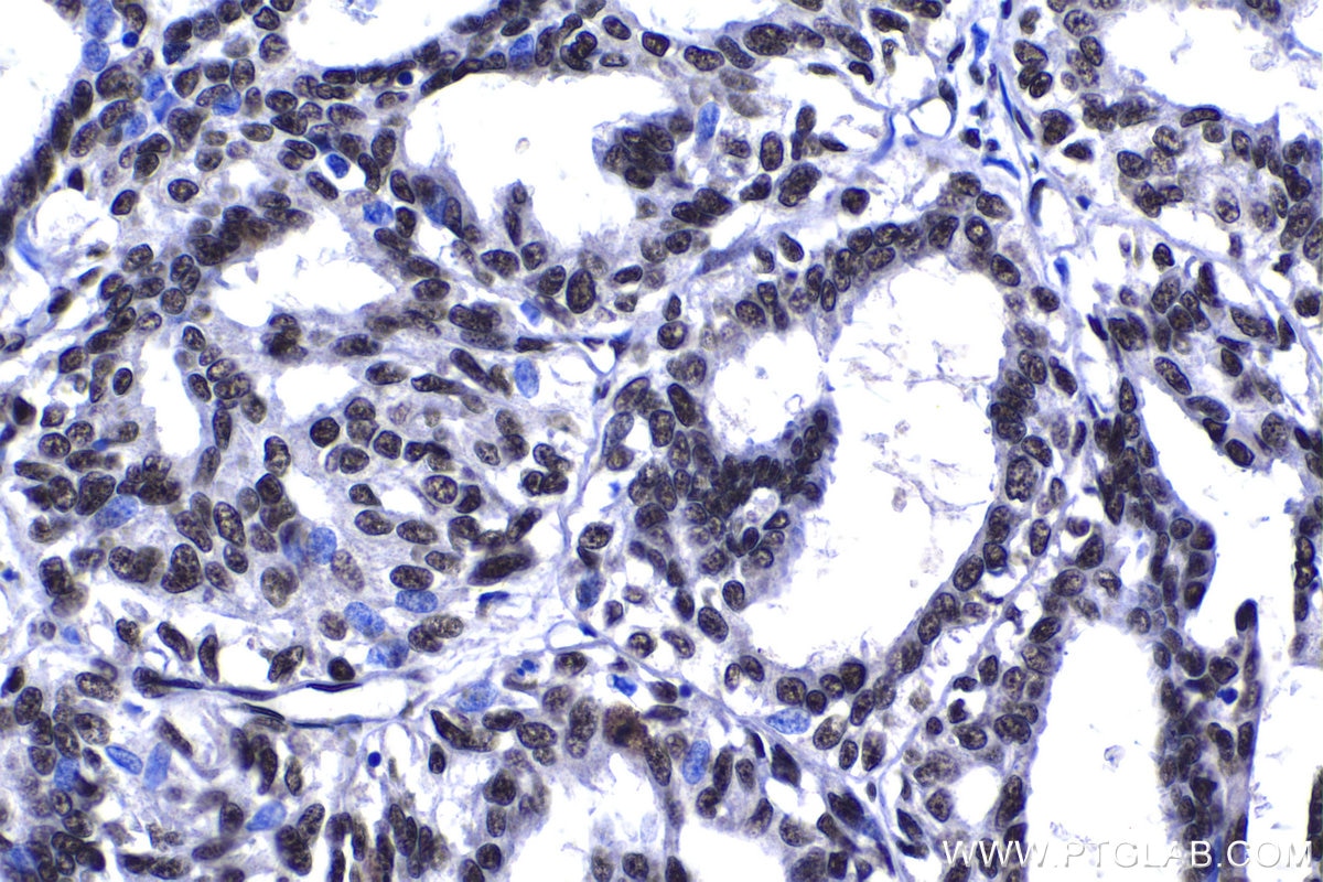 Immunohistochemical analysis of paraffin-embedded human breast cancer tissue slide using KHC1388 (CPSF6 IHC Kit).