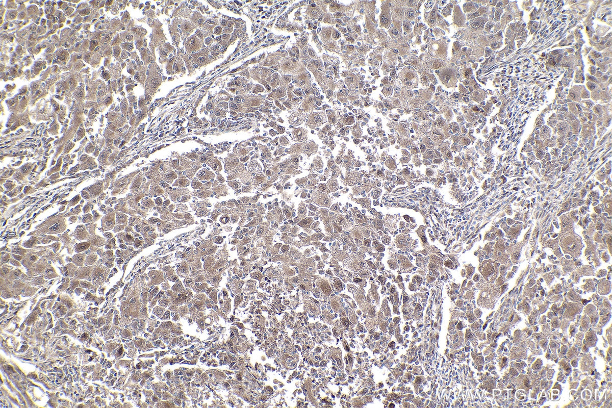 Immunohistochemical analysis of paraffin-embedded human lung cancer tissue slide using KHC1833 (CPSF7 IHC Kit).