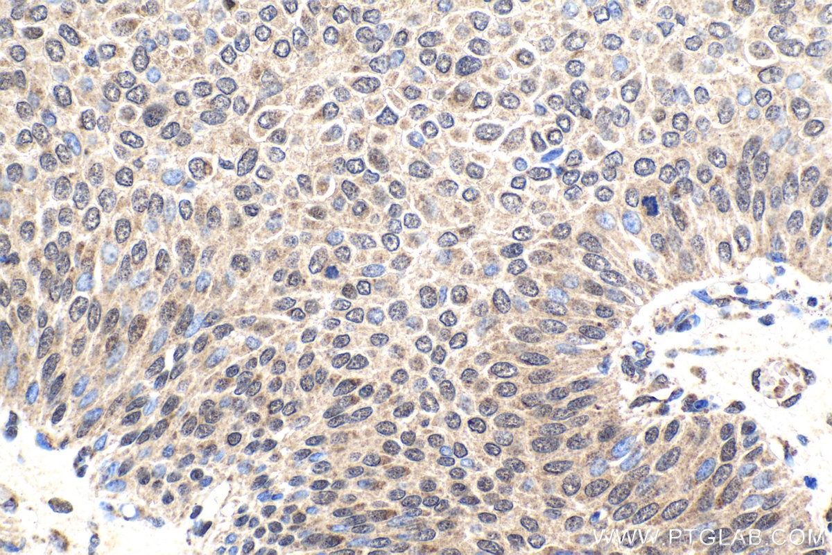 Immunohistochemical analysis of paraffin-embedded human urothelial carcinoma tissue slide using KHC1833 (CPSF7 IHC Kit).