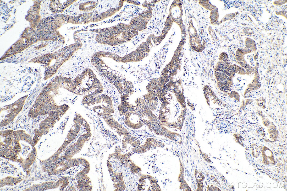 Immunohistochemical analysis of paraffin-embedded human colon cancer tissue slide using KHC0332 (CPT1A IHC Kit).