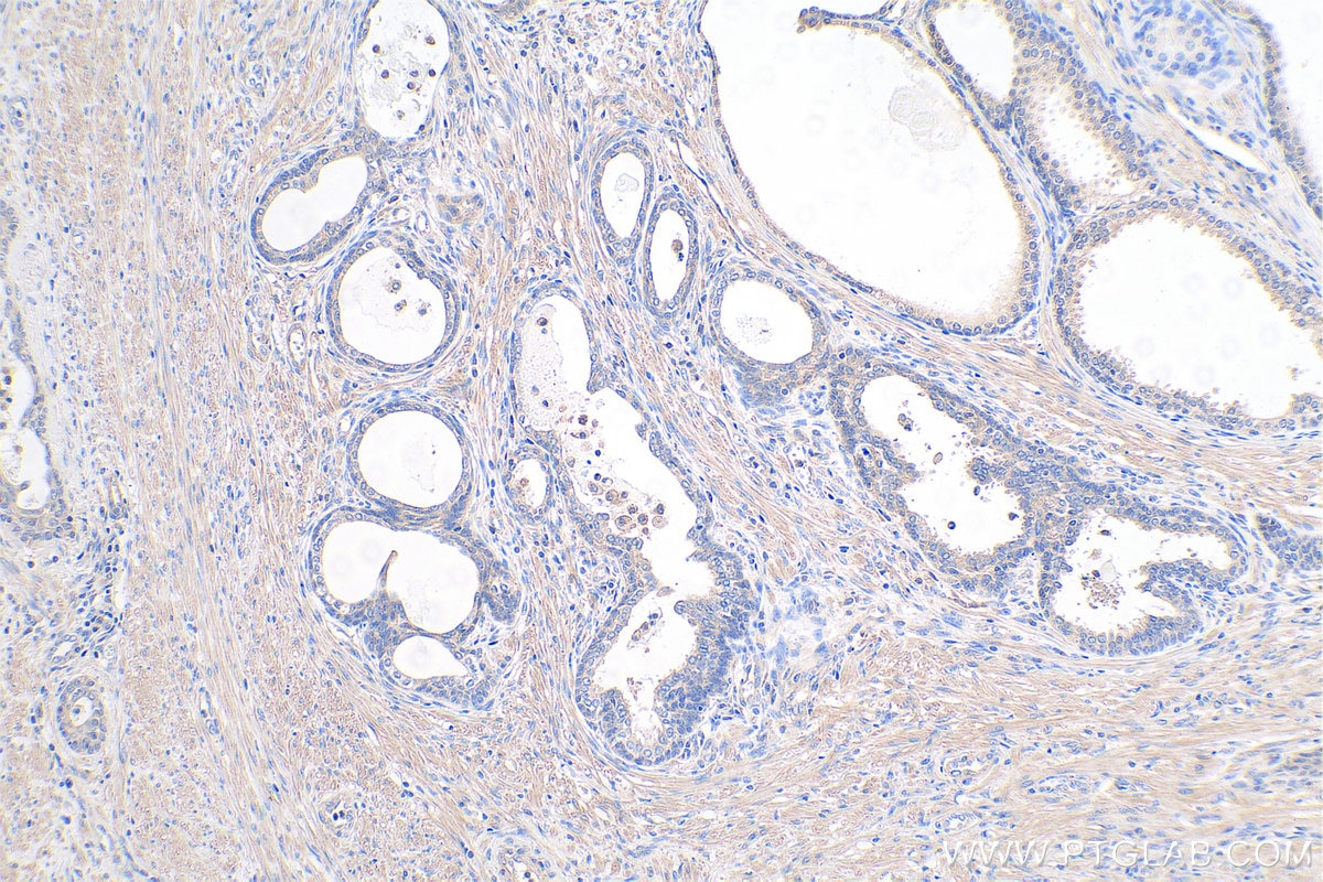 Immunohistochemical analysis of paraffin-embedded human prostate cancer tissue slide using KHC0363 (CPT1B-specific IHC Kit).