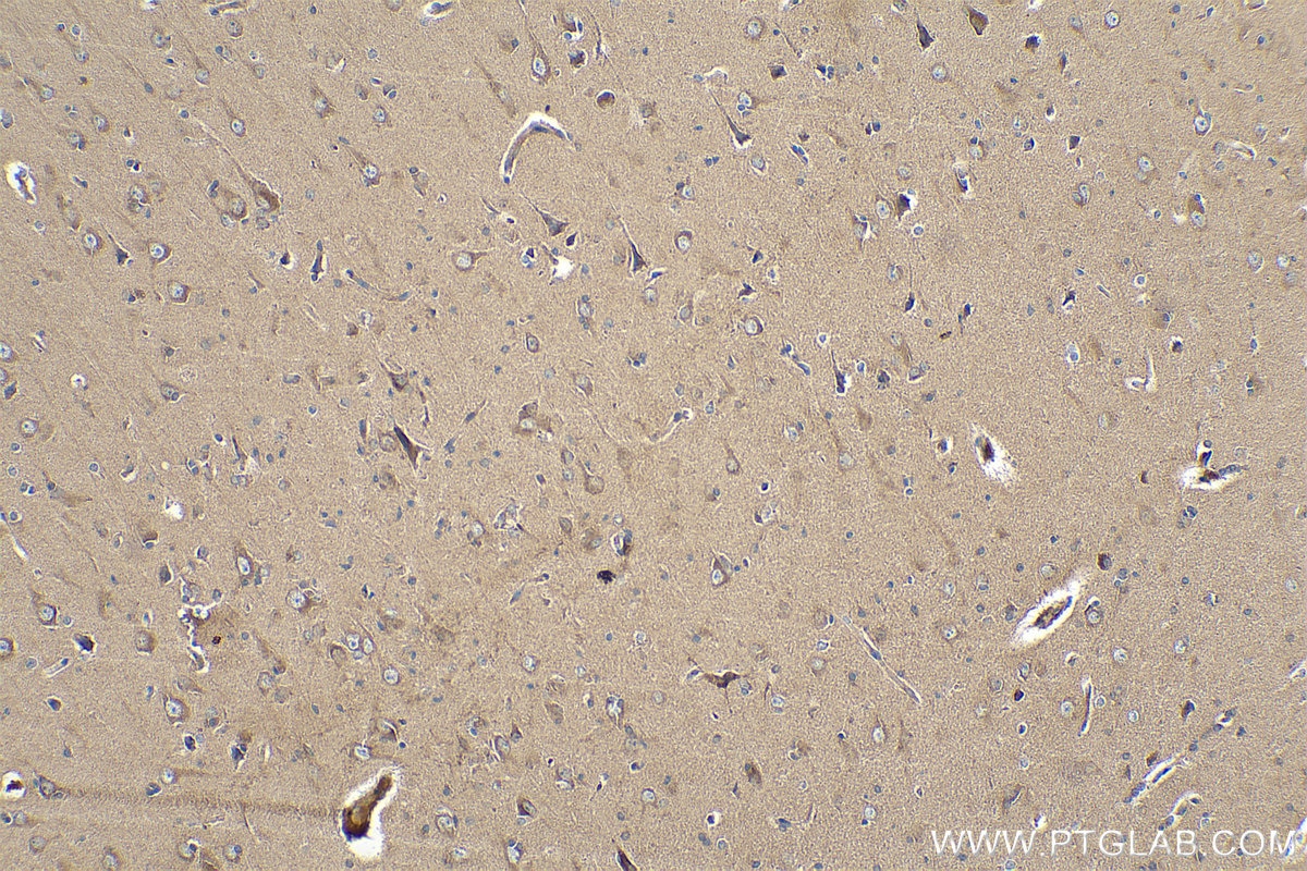 Immunohistochemical analysis of paraffin-embedded human gliomas tissue slide using KHC0333 (CPT1C IHC Kit).