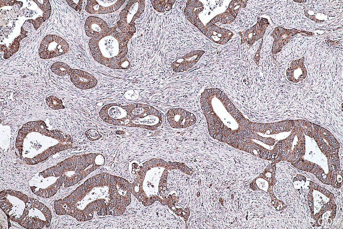 Immunohistochemical analysis of paraffin-embedded human colon cancer tissue slide using KHC0334 (CPT2 IHC Kit).