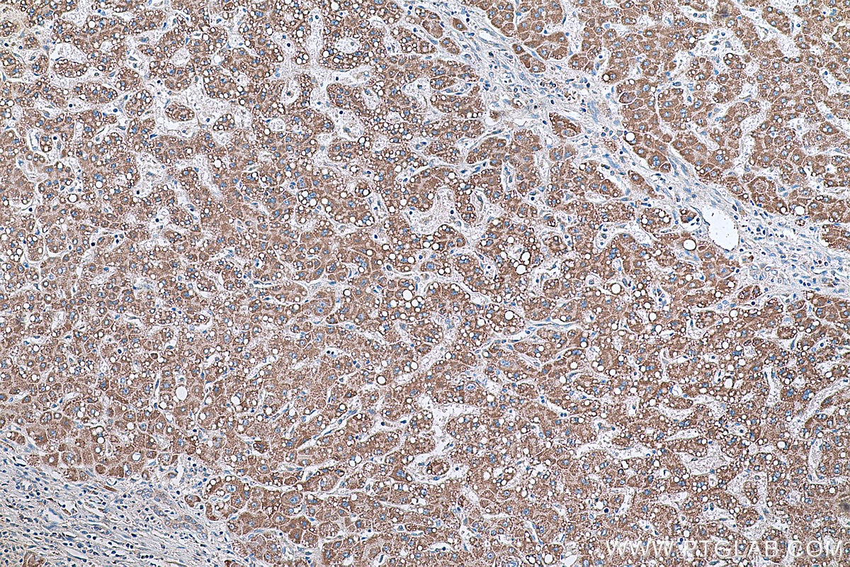 Immunohistochemical analysis of paraffin-embedded human liver cancer tissue slide using KHC0334 (CPT2 IHC Kit).