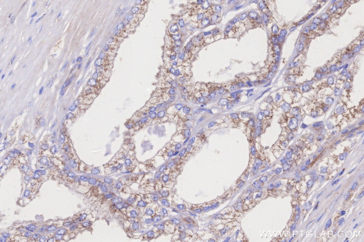 Immunohistochemical analysis of paraffin-embedded human prostate cancer tissue slide using KHC3263 (CPTP IHC Kit).