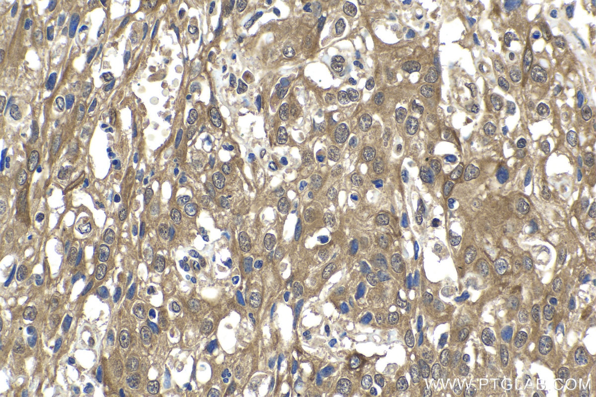 Immunohistochemical analysis of paraffin-embedded human cervical cancer tissue slide using KHC1654 (CRADD IHC Kit).