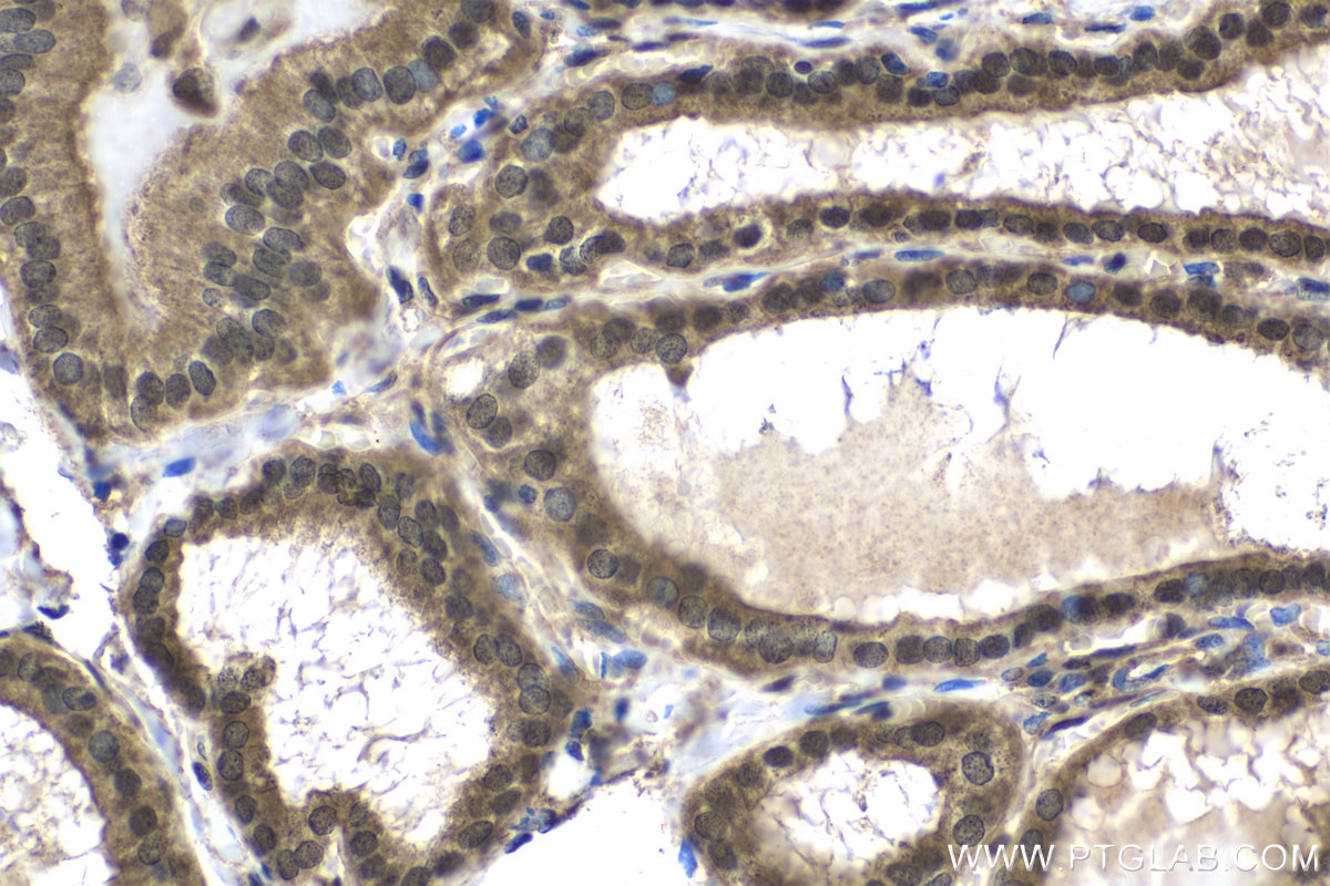 Immunohistochemical analysis of paraffin-embedded human thyroid cancer tissue slide using KHC1654 (CRADD IHC Kit).