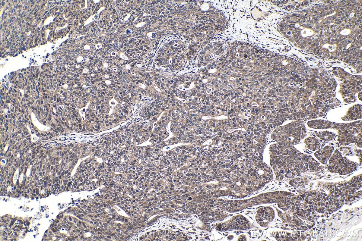 Immunohistochemical analysis of paraffin-embedded human ovary tumor tissue slide using KHC1019 (CRCP IHC Kit).