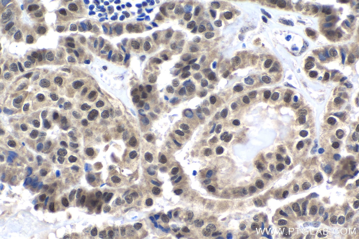 Immunohistochemical analysis of paraffin-embedded human thyroid cancer tissue slide using KHC1019 (CRCP IHC Kit).