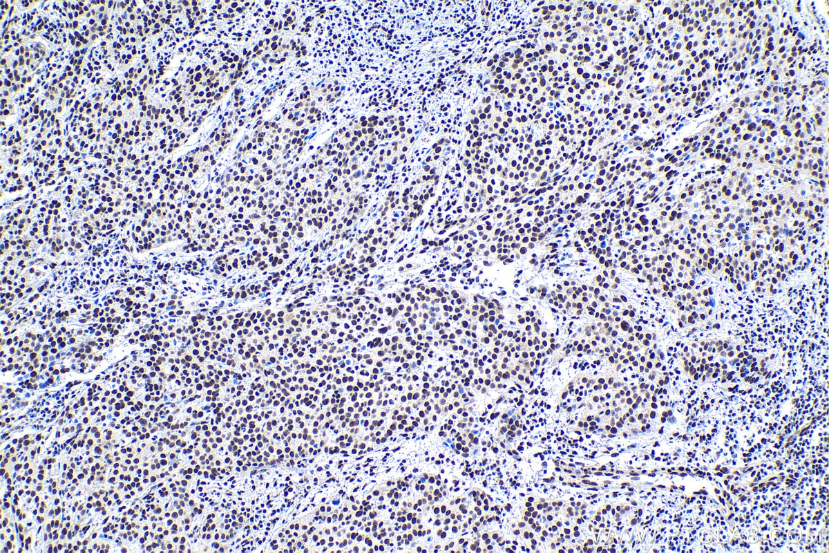 Immunohistochemical analysis of paraffin-embedded human cervical cancer tissue slide using KHC1124 (CREB1 IHC Kit).
