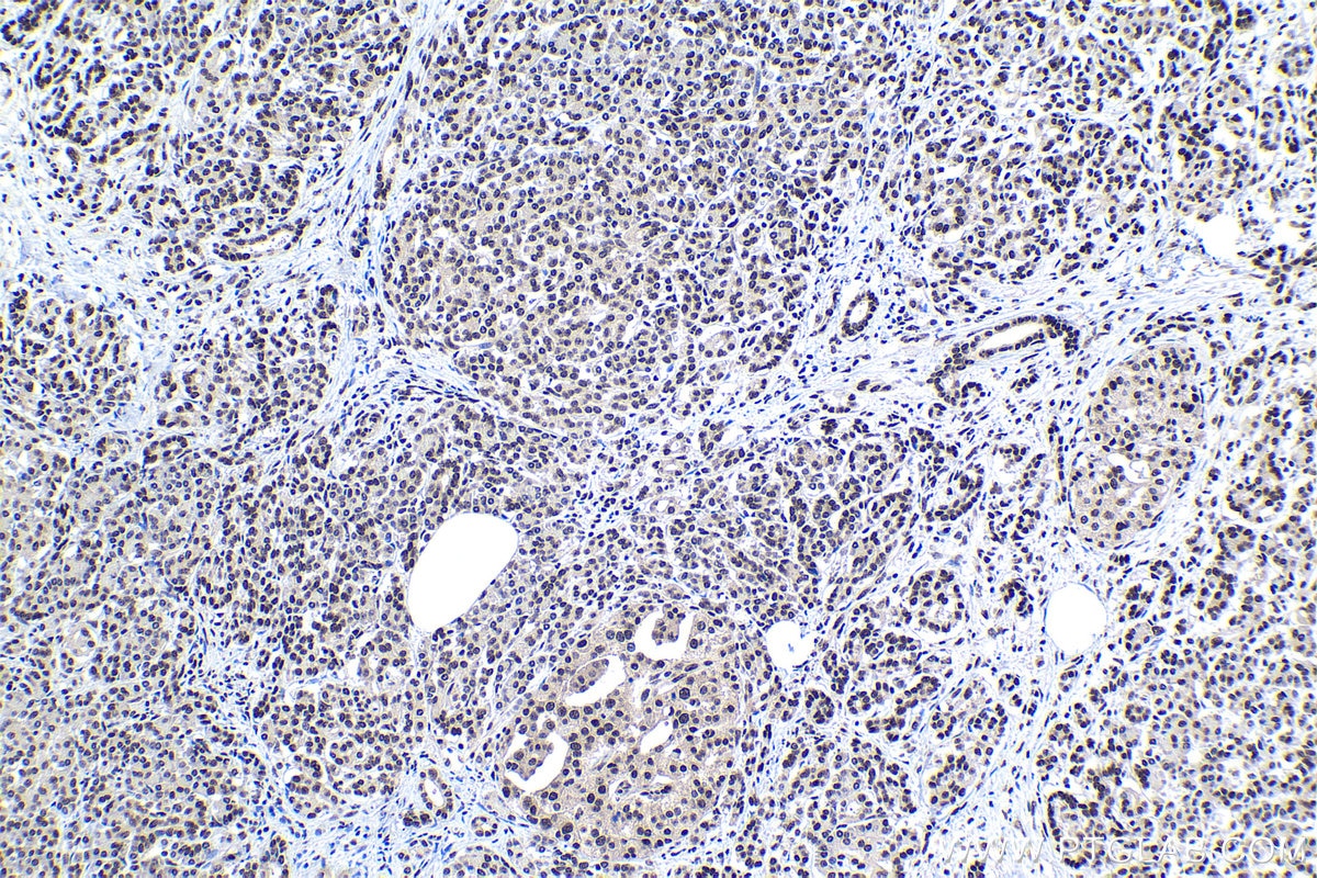 Immunohistochemical analysis of paraffin-embedded human pancreas cancer tissue slide using KHC1124 (CREB1 IHC Kit).
