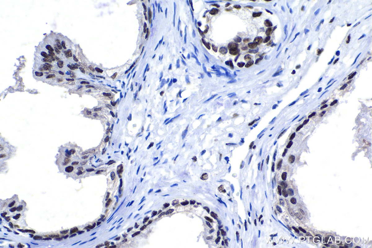 Immunohistochemical analysis of paraffin-embedded human prostate cancer tissue slide using KHC1124 (CREB1 IHC Kit).