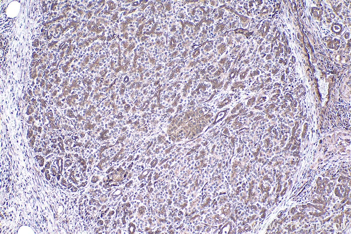 Immunohistochemical analysis of paraffin-embedded human pancreas cancer tissue slide using KHC1458 (CREB3 IHC Kit).