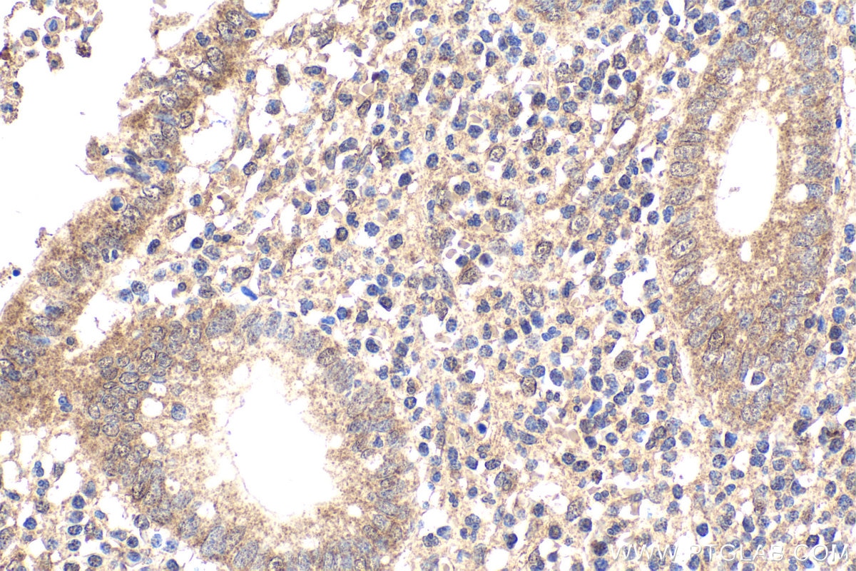 Immunohistochemical analysis of paraffin-embedded human appendicitis tissue slide using KHC1868 (CREB3L1 IHC Kit).