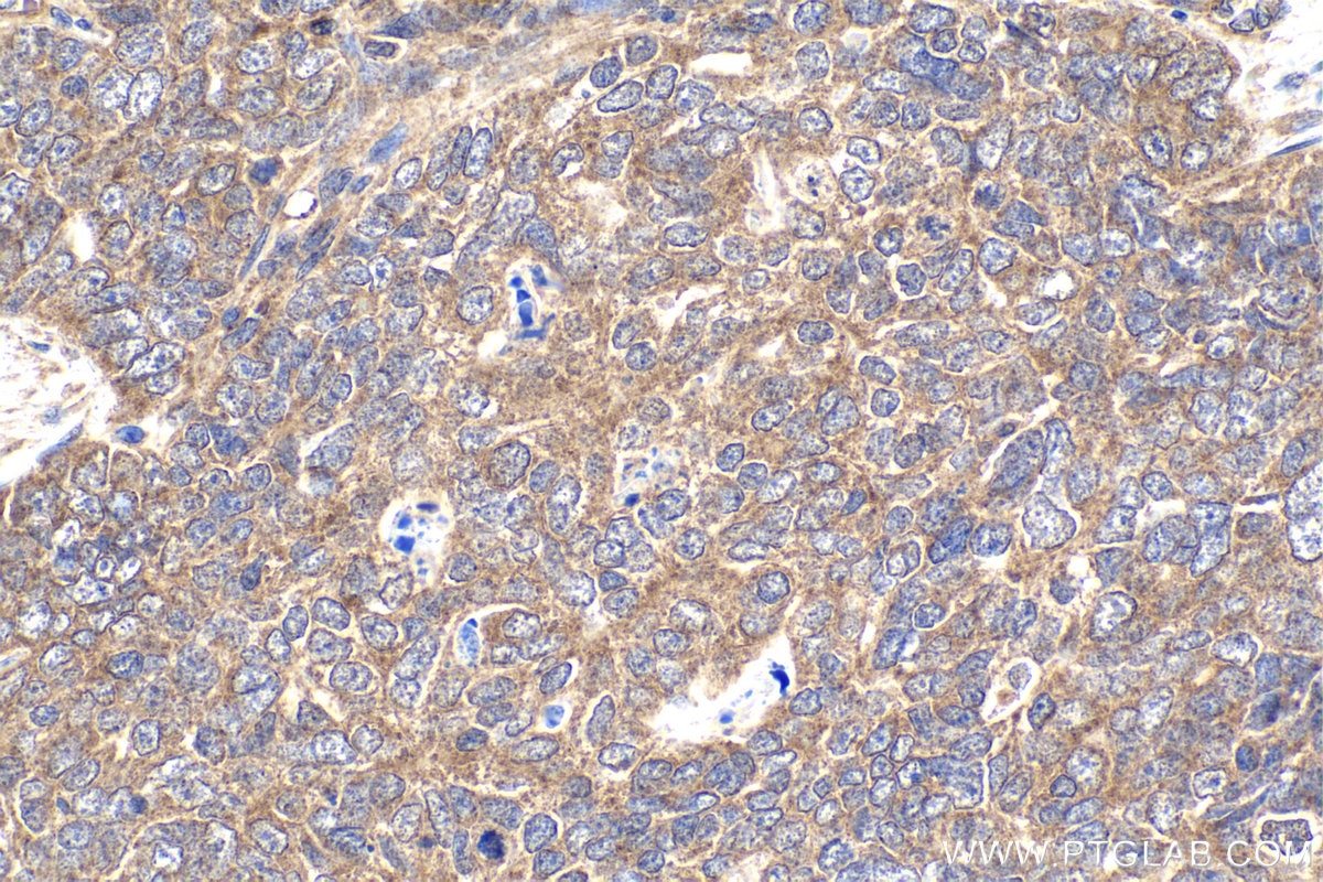 Immunohistochemical analysis of paraffin-embedded human ovary tumor tissue slide using KHC1868 (CREB3L1 IHC Kit).