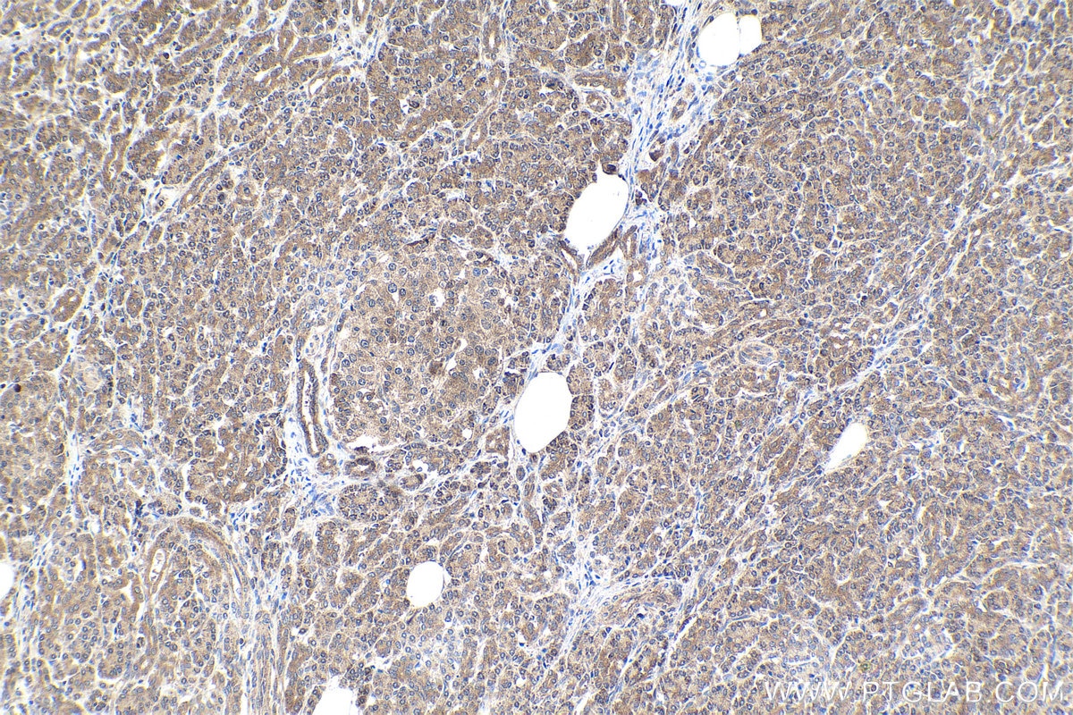 Immunohistochemical analysis of paraffin-embedded human pancreas cancer tissue slide using KHC1795 (CREB3L2 IHC Kit).