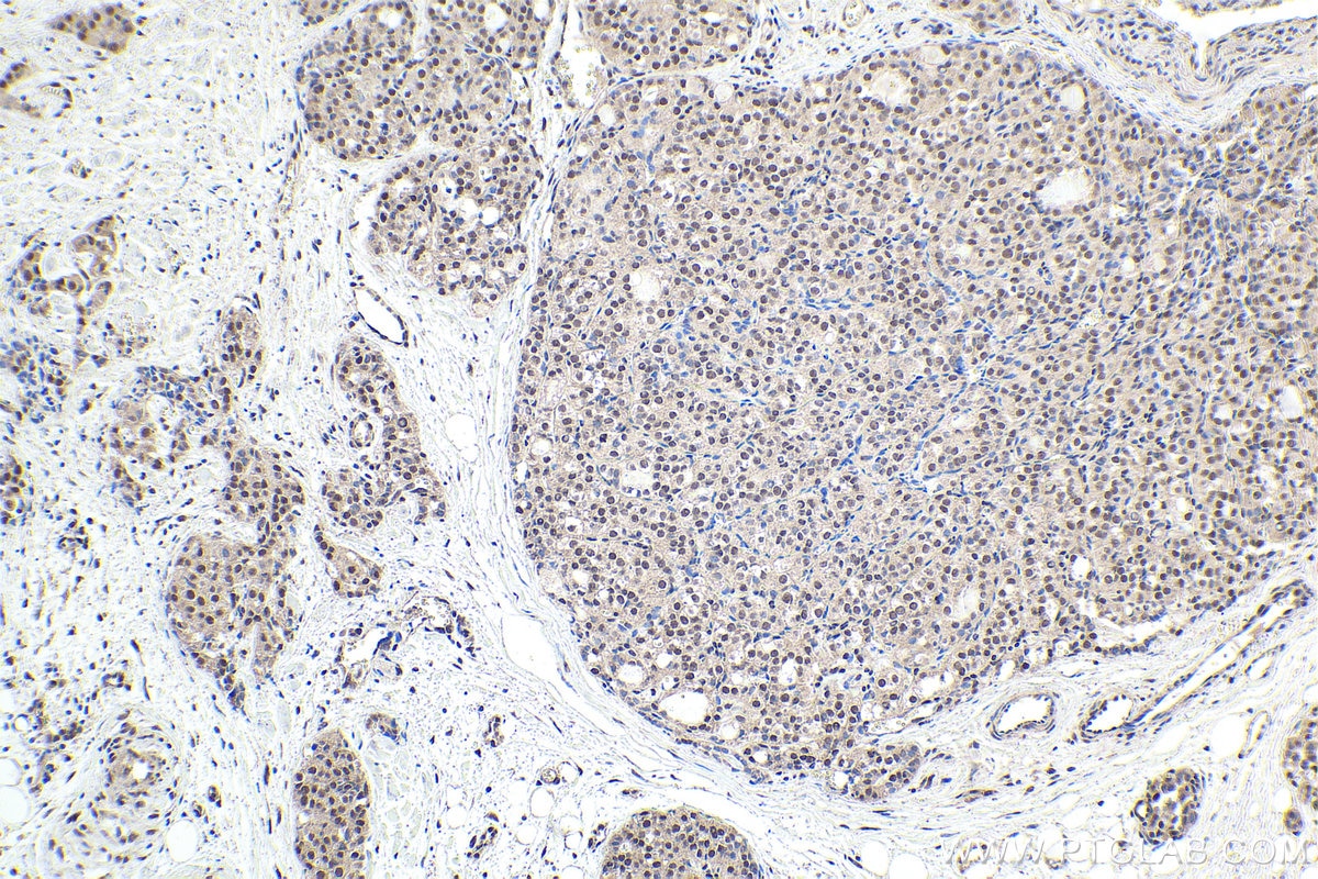 Immunohistochemical analysis of paraffin-embedded human thyroid cancer tissue slide using KHC1856 (CREBBP IHC Kit).