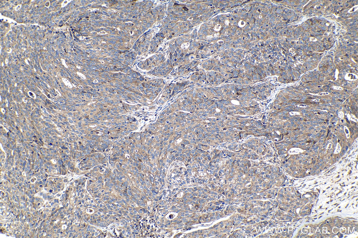 Immunohistochemical analysis of paraffin-embedded human ovary tumor tissue slide using KHC1111 (CRISP3 IHC Kit).