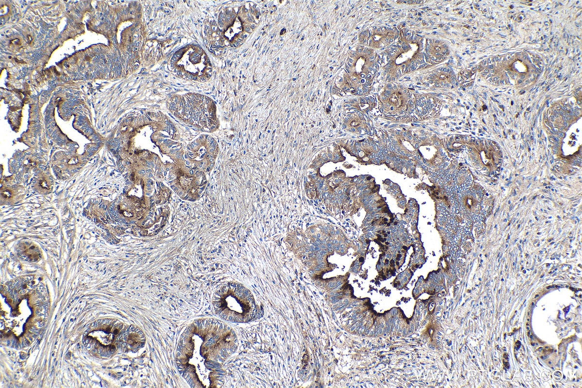 Immunohistochemical analysis of paraffin-embedded human pancreas cancer tissue slide using KHC1111 (CRISP3 IHC Kit).