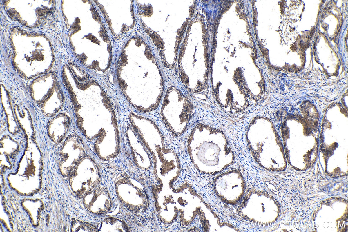 Immunohistochemical analysis of paraffin-embedded human prostate cancer tissue slide using KHC1111 (CRISP3 IHC Kit).